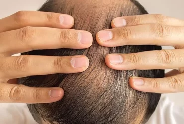 Can HIV Patients have a Hair Transplant?