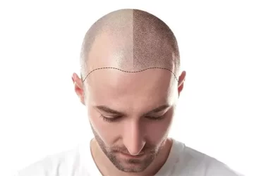 Which Hair Transplant Clinic Is The Best?