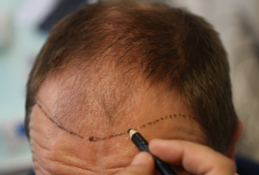 Unshaven FUE Hair Transplant