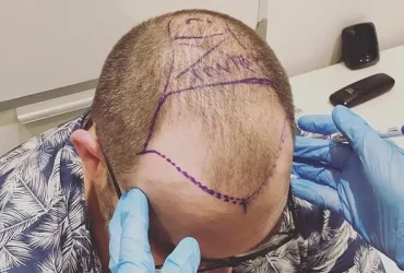 10 Things To Know About Hair Transplant Without Shaving