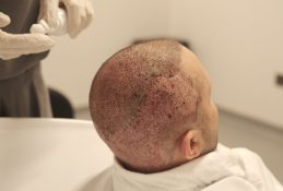 How to Hide Fue Hair Transplant?