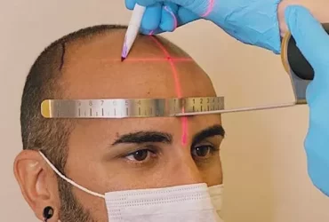 How To Sleep After FUE Hair Transplant?